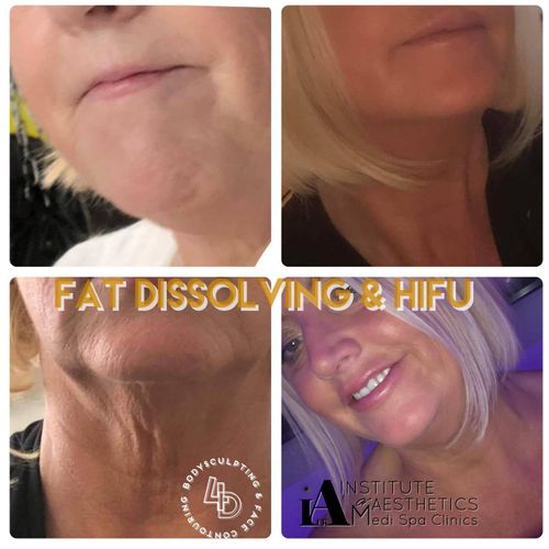 Fat Dissolving & RF Micro Needling